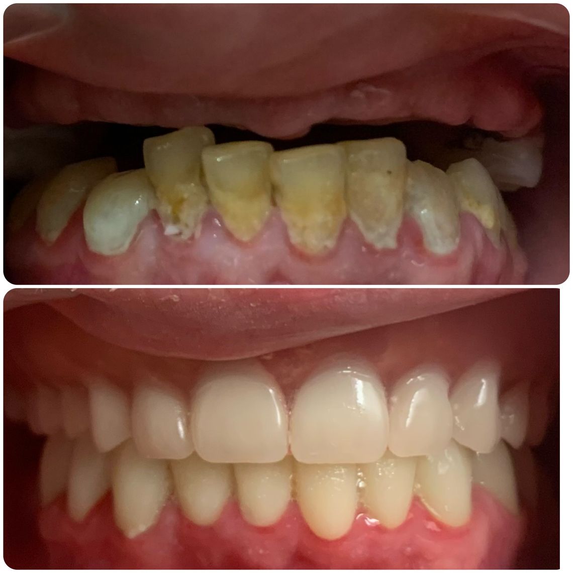 teeth bleaching east village