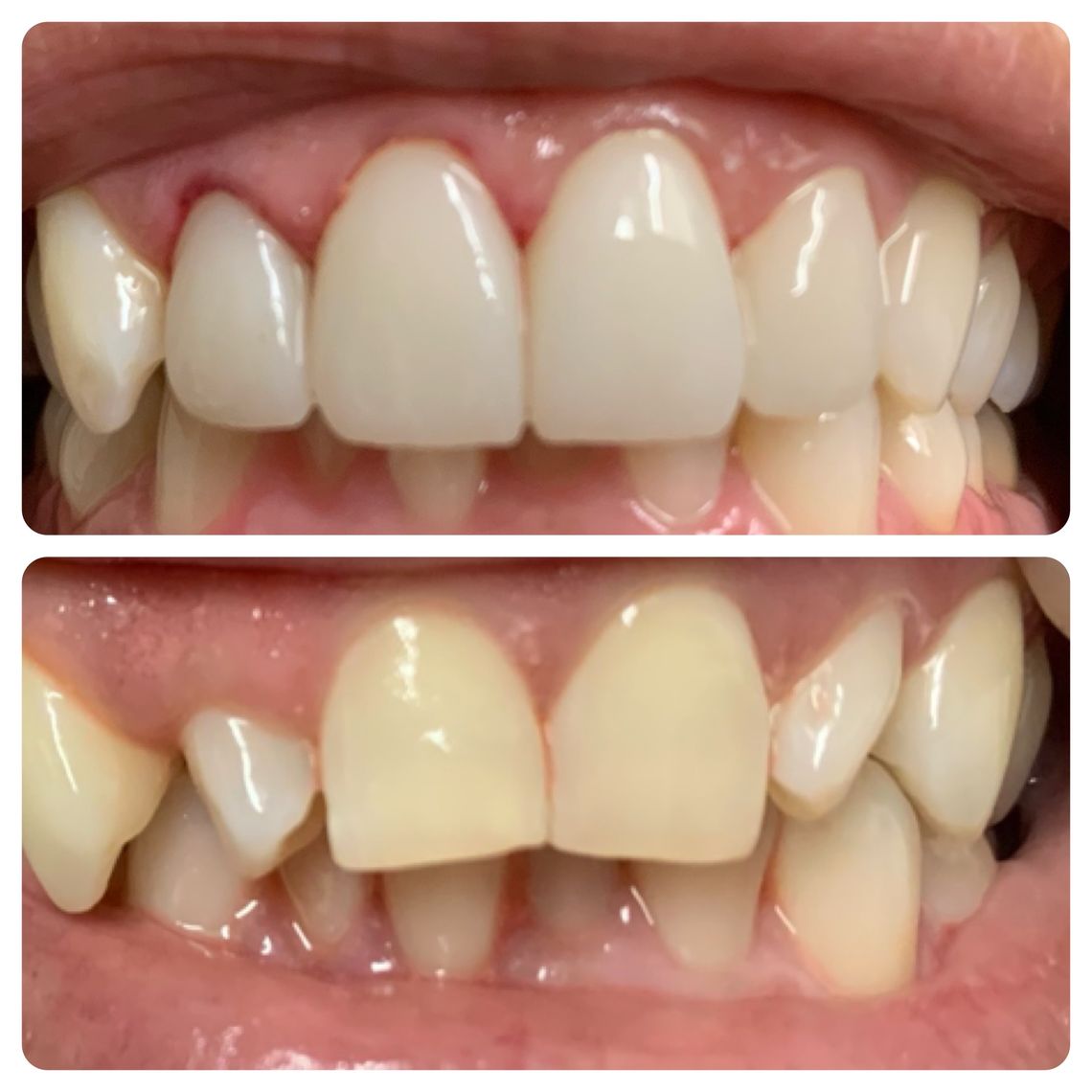 best teeth whitening treatment east village