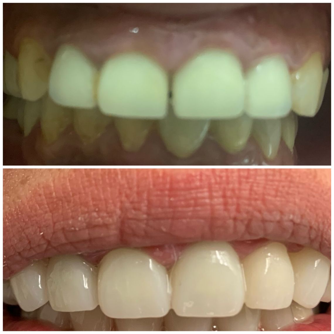 best teeth whitening treatment east village & Howard Beach