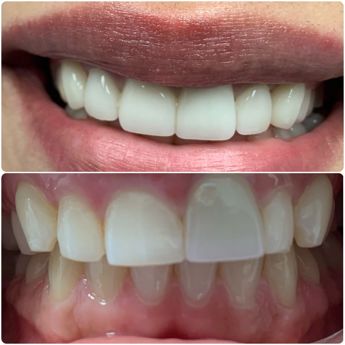 teeth bleaching east village