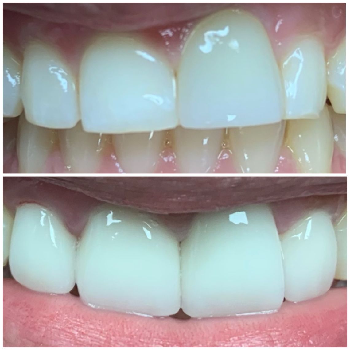 best teeth whitening treatment east village