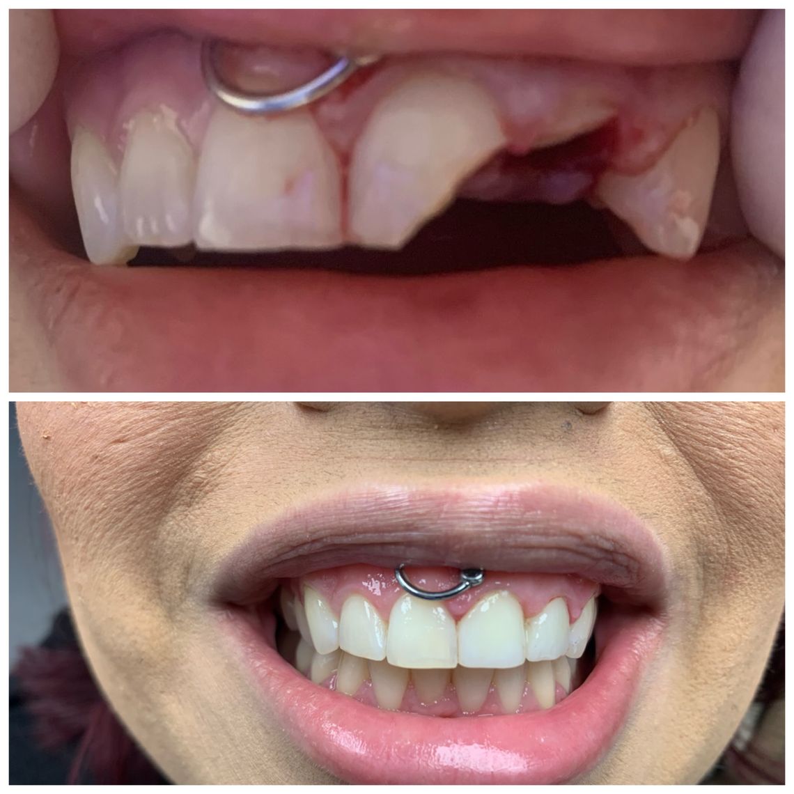 best teeth whitening treatment east village