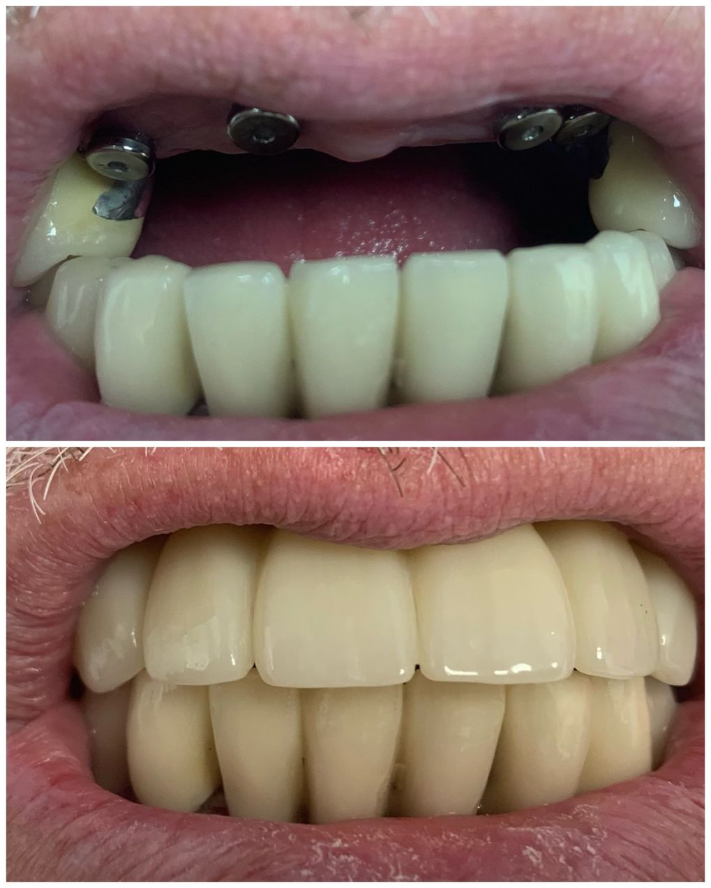 best teeth whitening treatment east village
