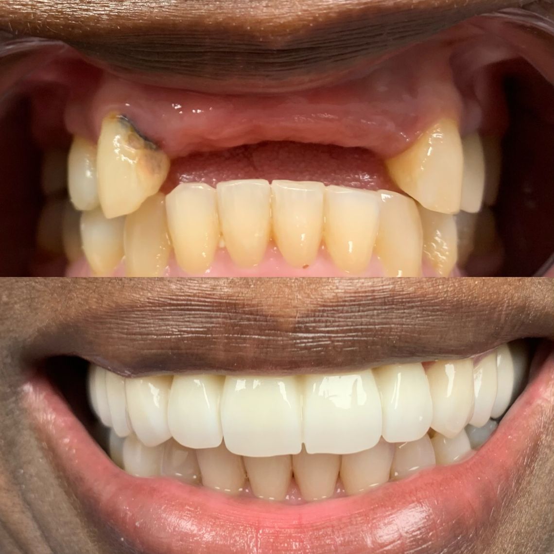 full mouth dental implants east village