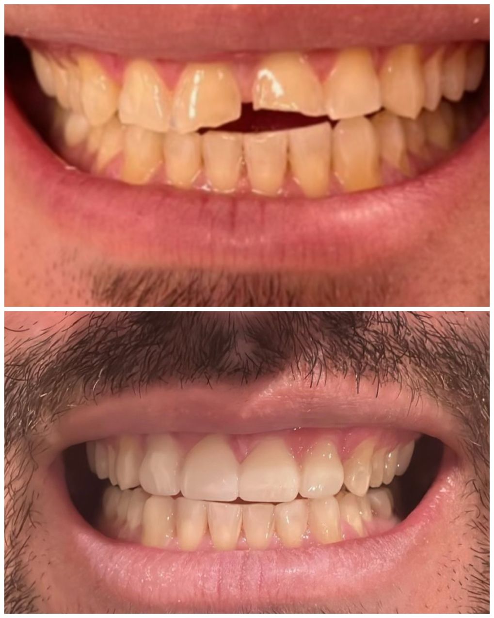 full mouth dental implants east village
