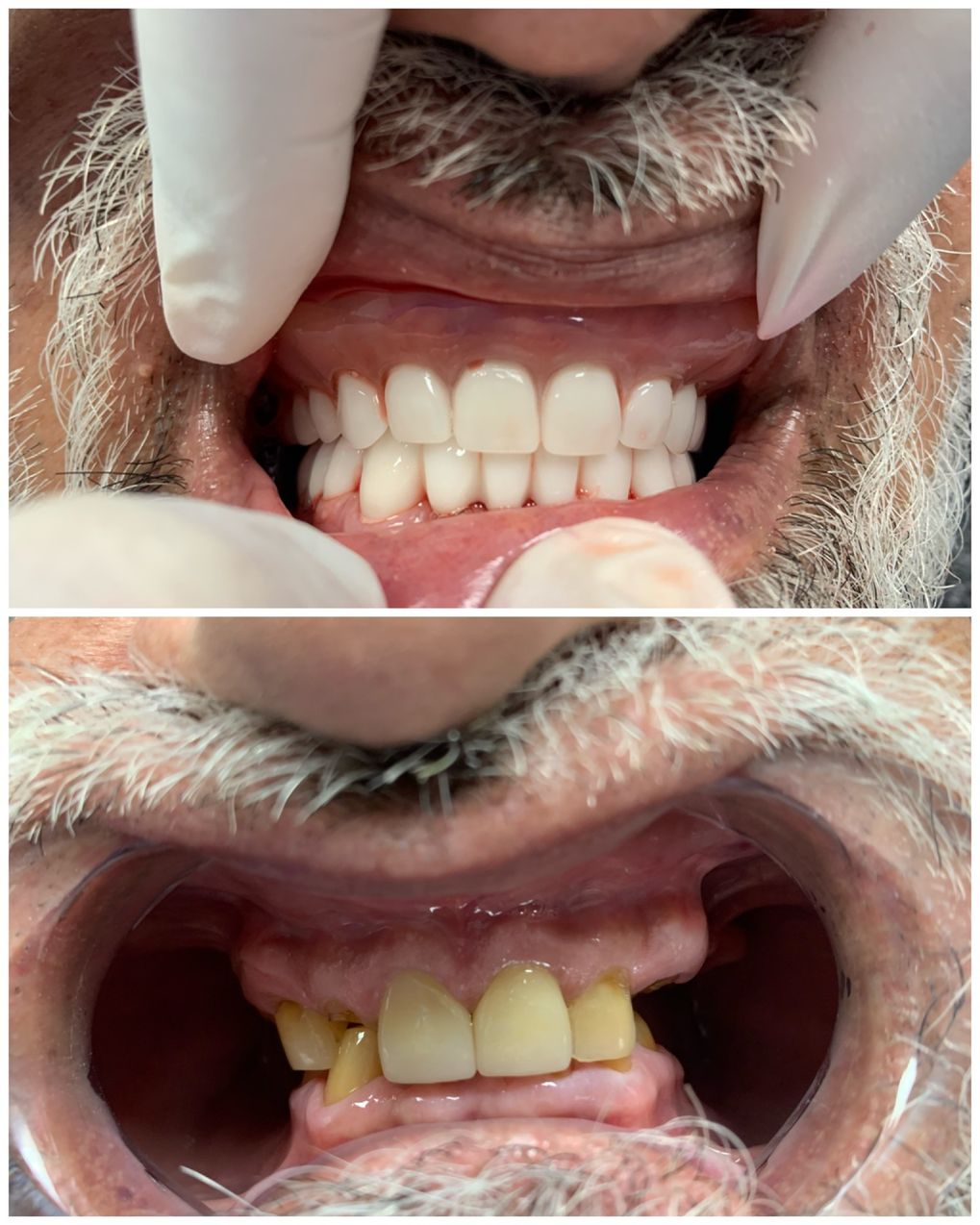 full mouth dental implants east village