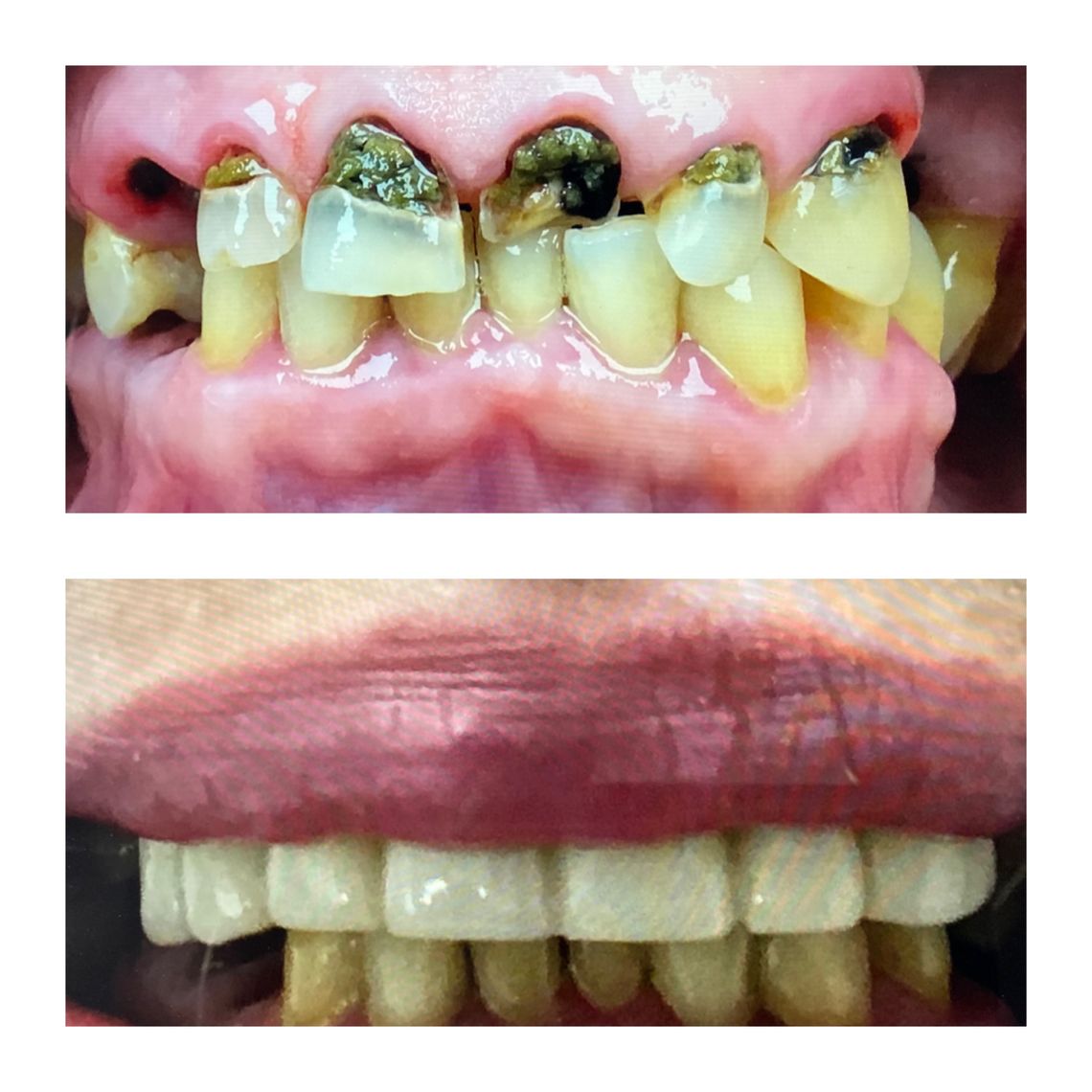 full mouth dental implants east village