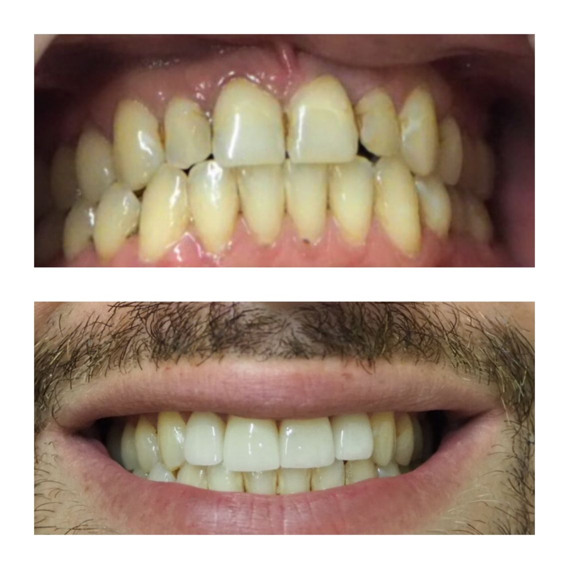 full mouth dental implants east village