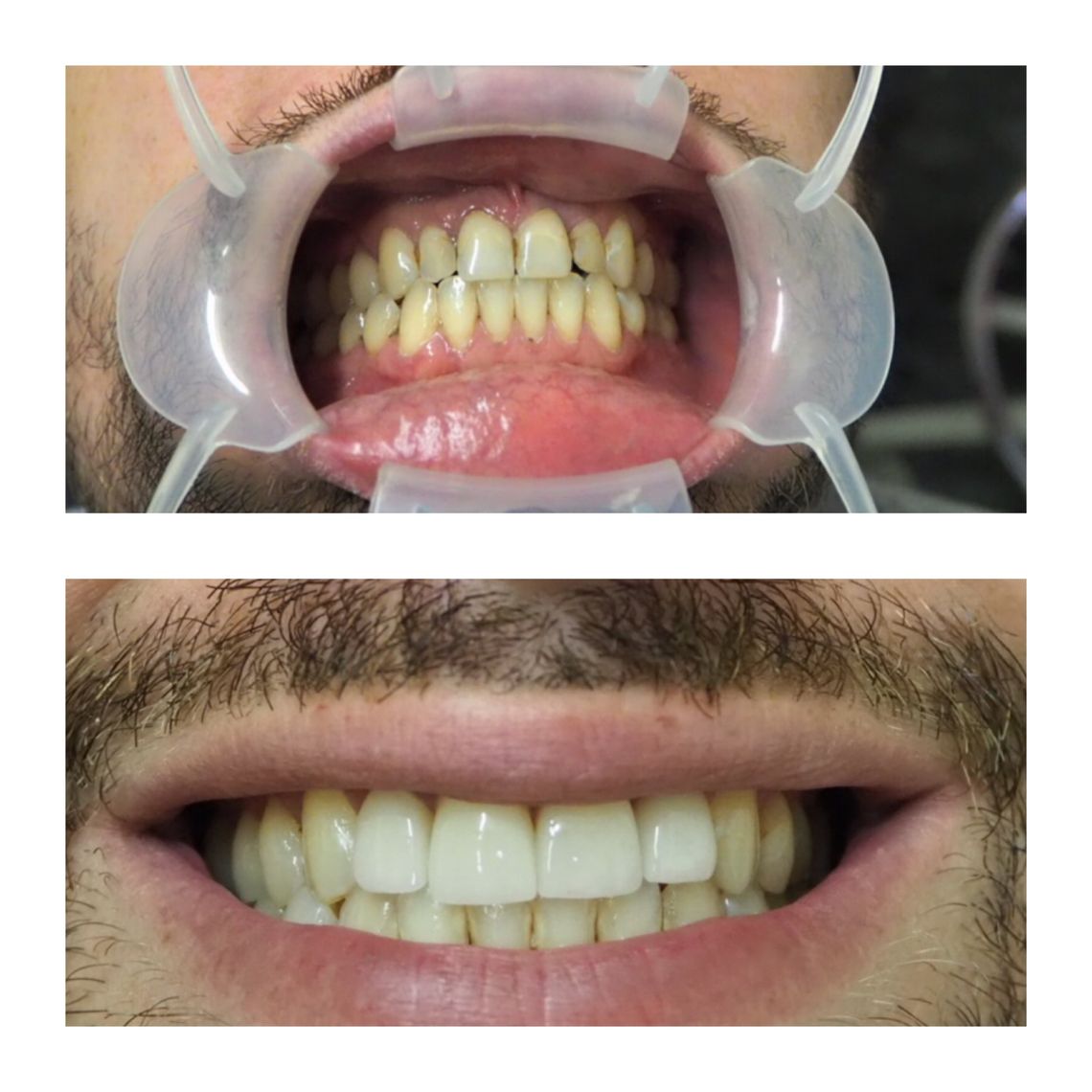 teeth bleaching east village