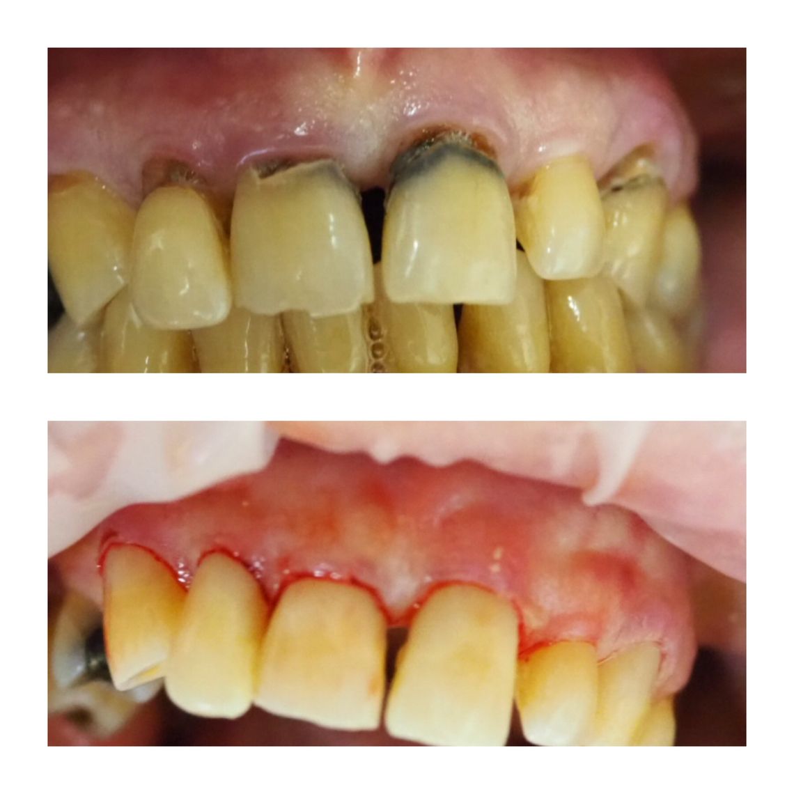 teeth bleaching east village