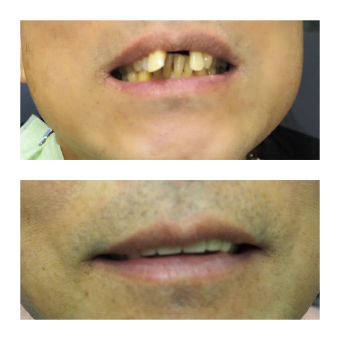 full mouth dental implants east village