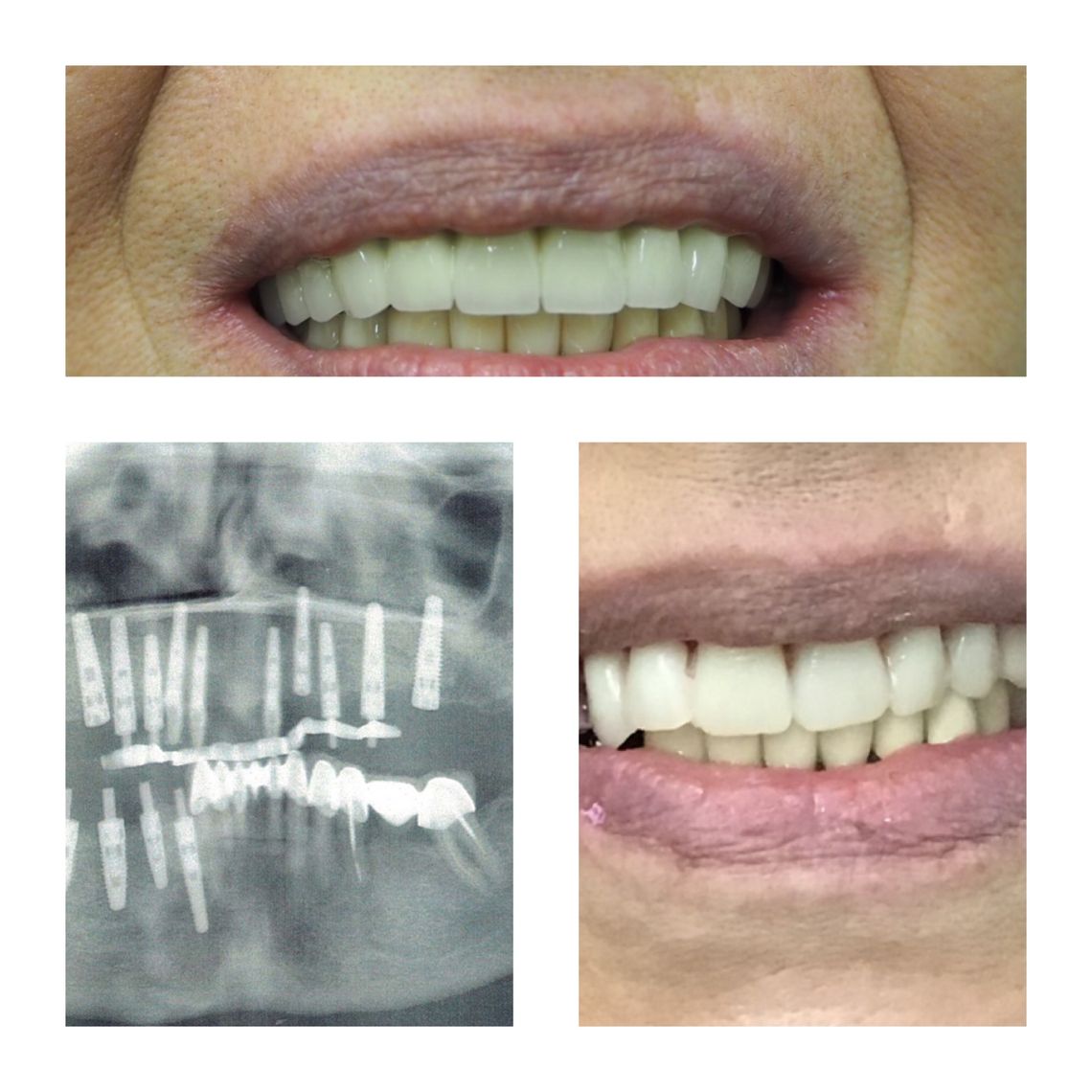 full mouth dental implants east village