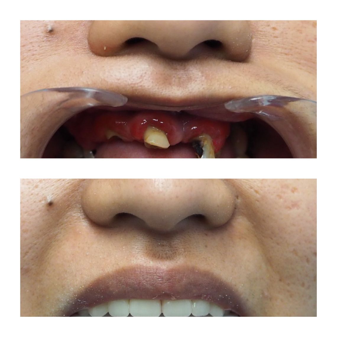 best teeth whitening treatment east village