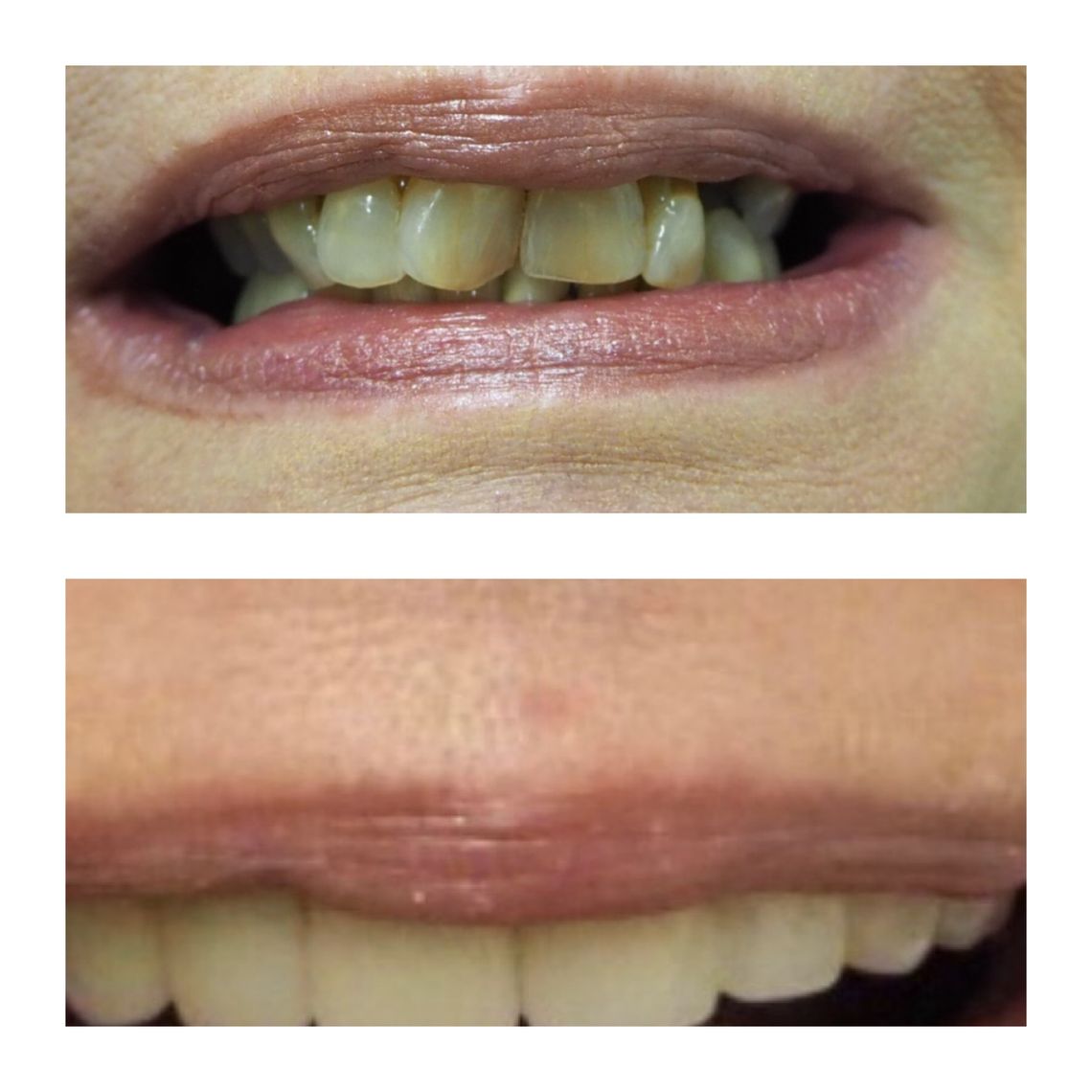 best teeth whitening treatment east village