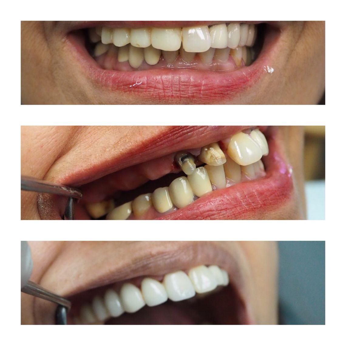 teeth bleaching east village