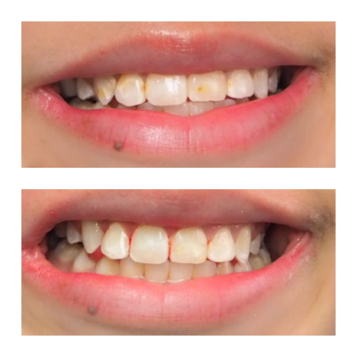 best teeth whitening treatment east village & Howard Beach