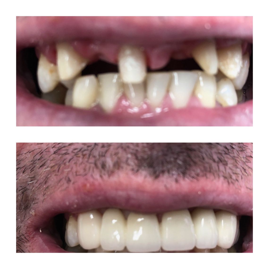 best teeth whitening treatment east village