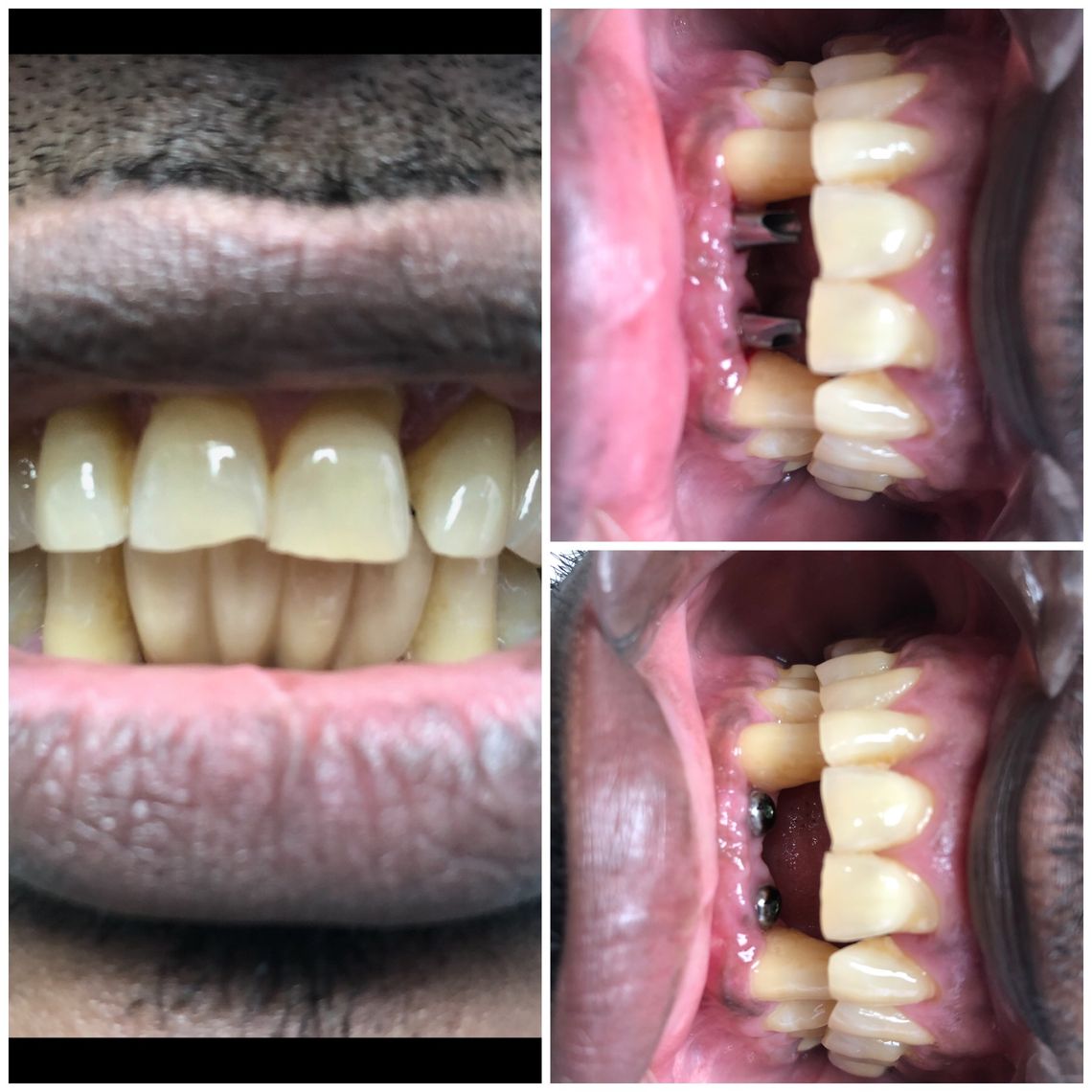 full dental implants east village