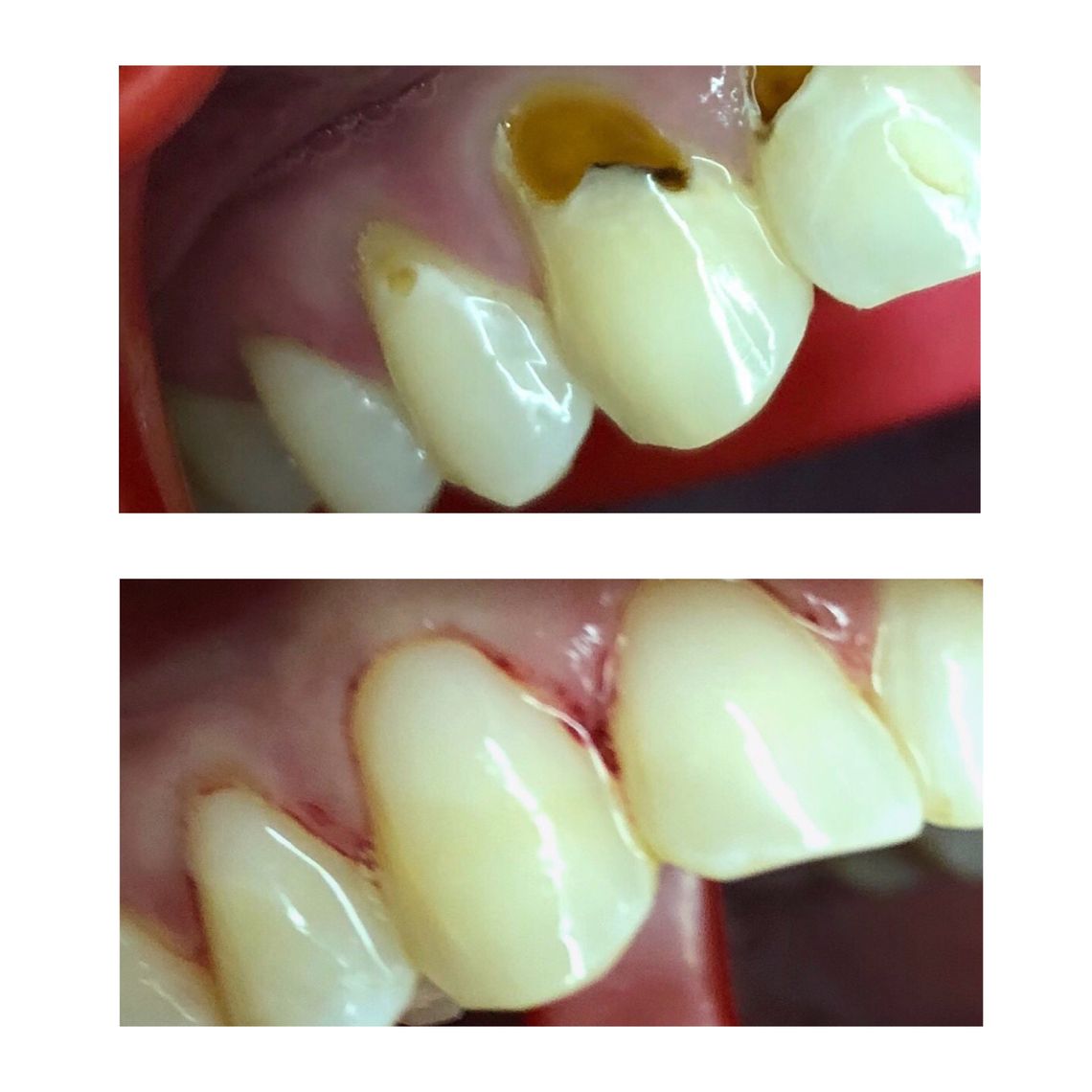 best teeth whitening treatment east village