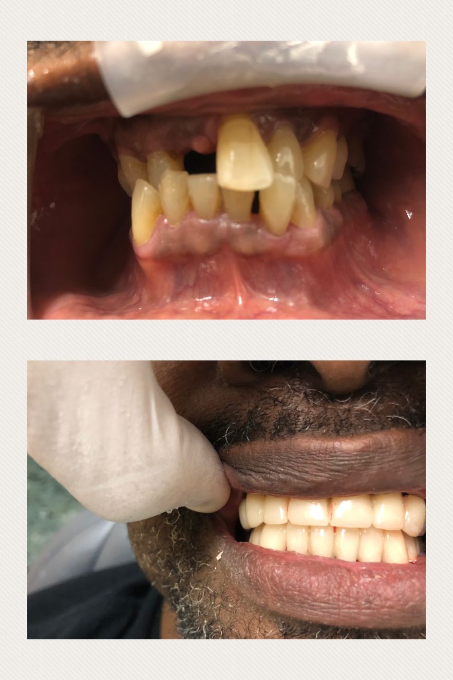 full mouth dental implants east village