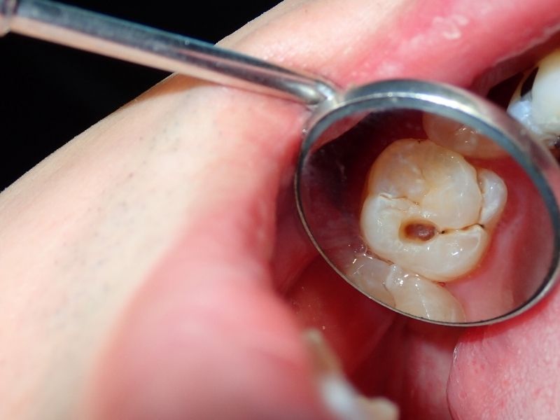 Porcelain Filling Procedure