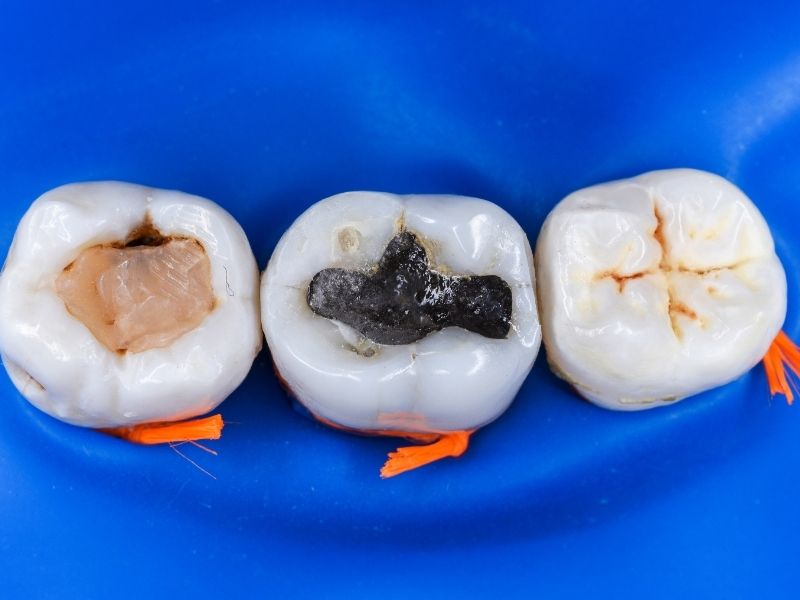 Three molar teeth isolated with a blue dental dam, showing different stages of tooth restoration: one with a cavity prepared, one with an old dark amalgam filling, and one with a sealed or restored occlusal surface.