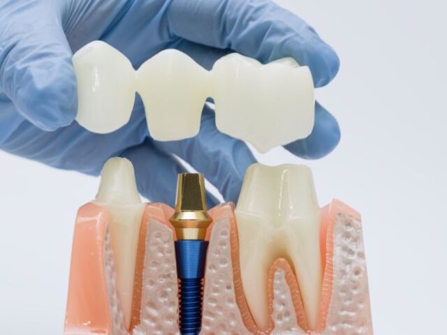 Dental Implants vs. Bridges: Which Is Right for You?