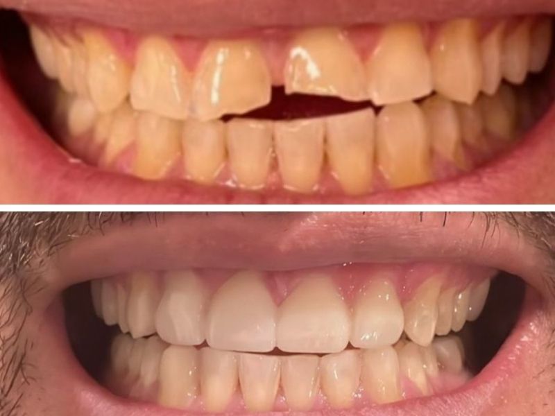 Chipped Tooth Repair NYC – Same-Day Emergency Dentist in Manhattan