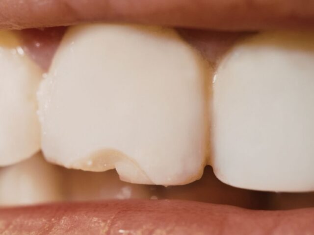 How to Fix a Chipped or Cracked Tooth Fast