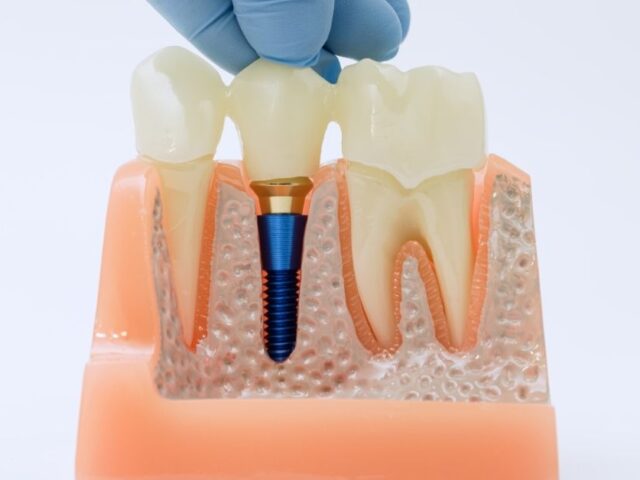 Are Dental Implants Worth the Cost? What Patients Should Really Know