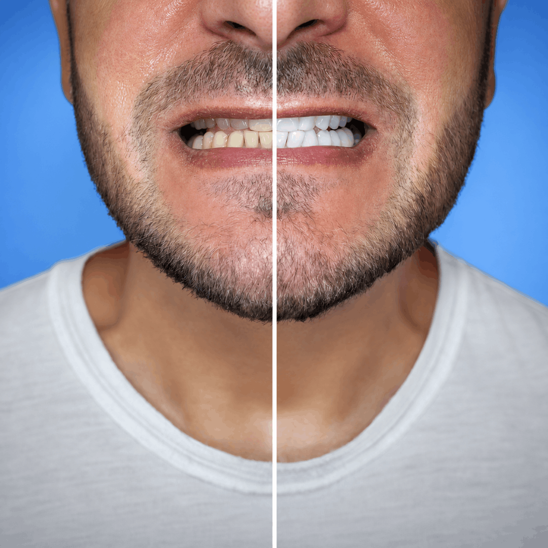 Cosmetic smile makeover treatment