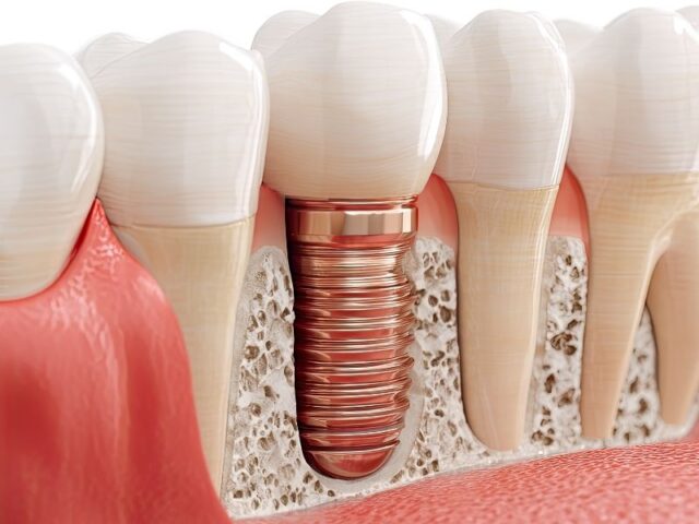 Single Tooth Dental Implant Manhattan: Are You a Candidate?