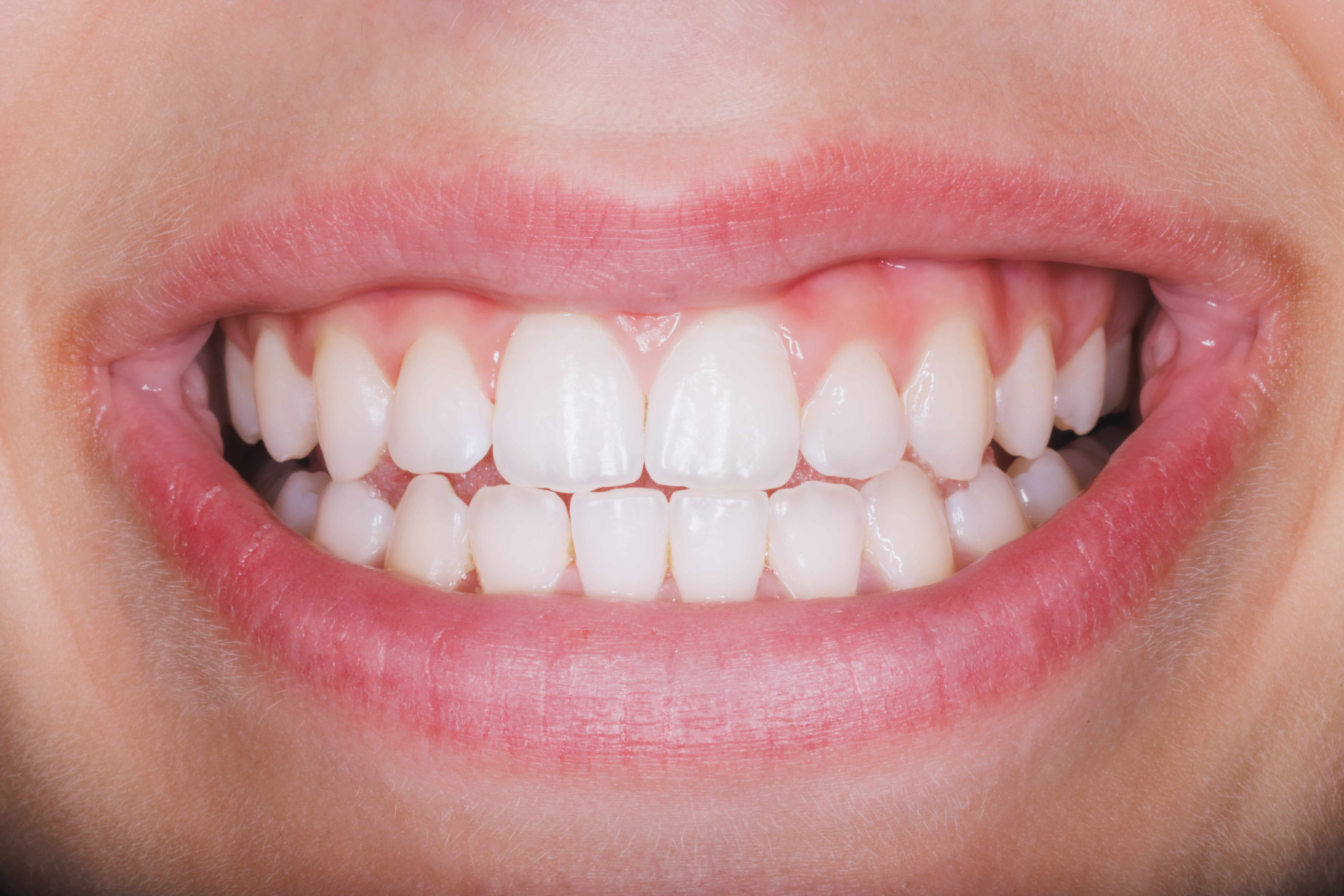 Dental bleaching and teeth whitening in Howard Beach, NY