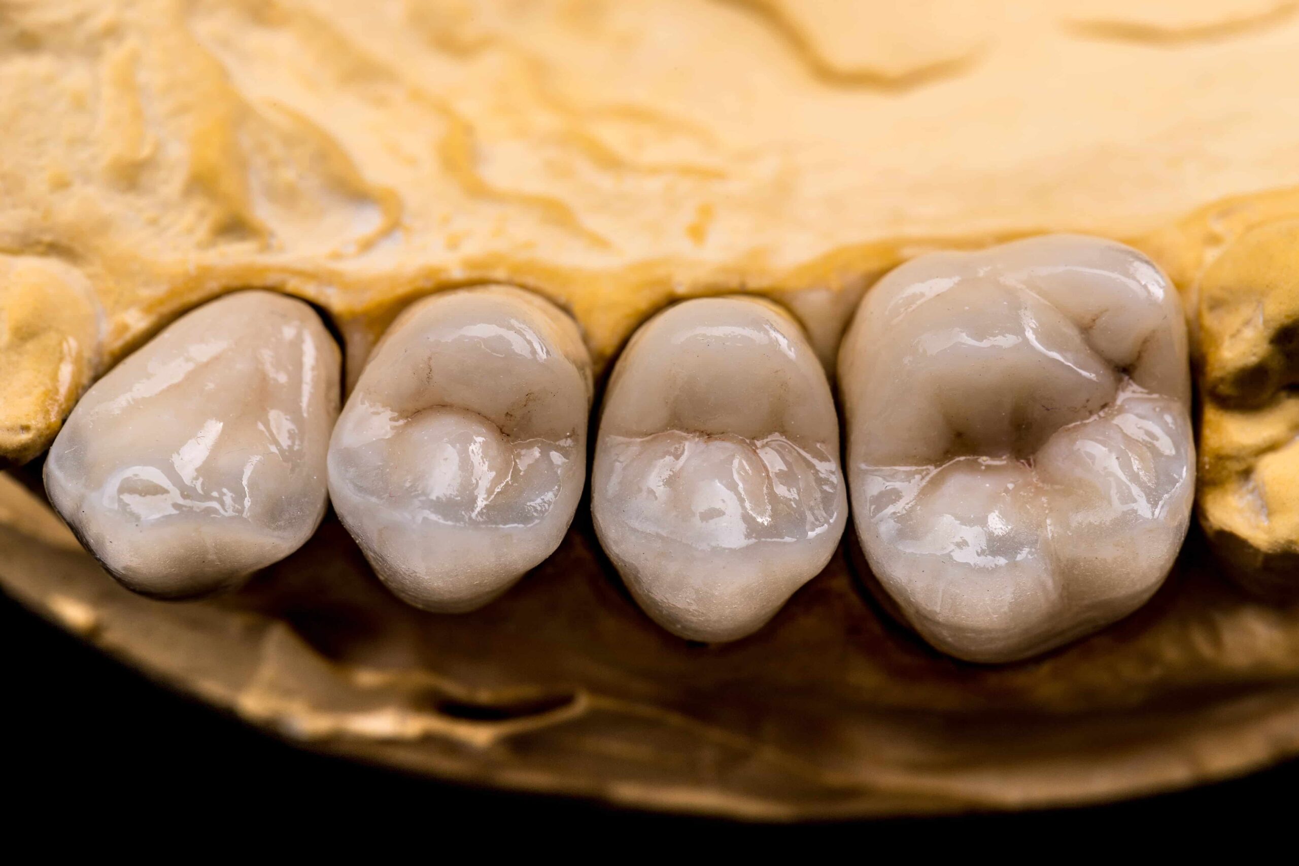 Porcelain tooth-colored fillings