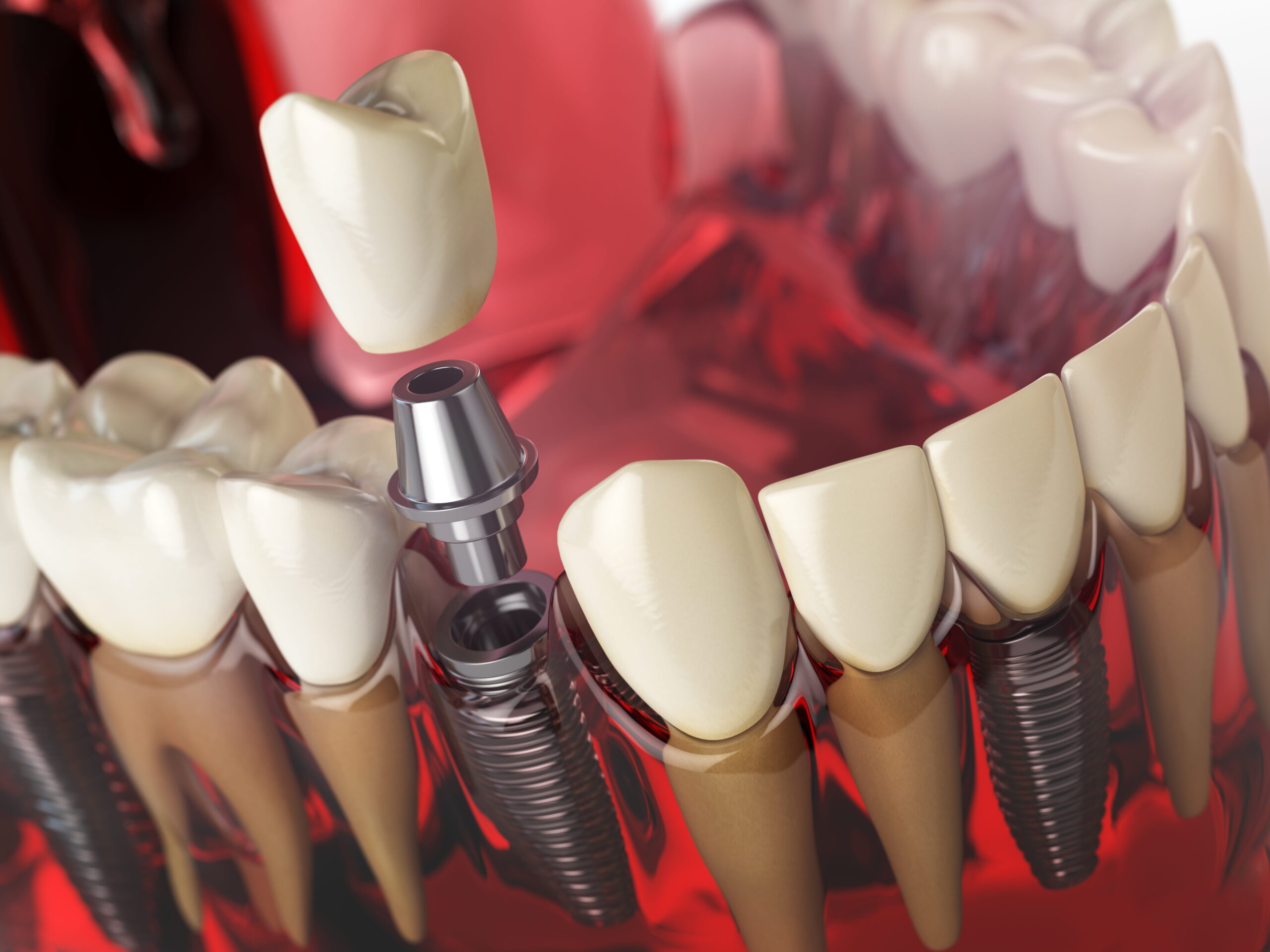 Dental crowns restoration