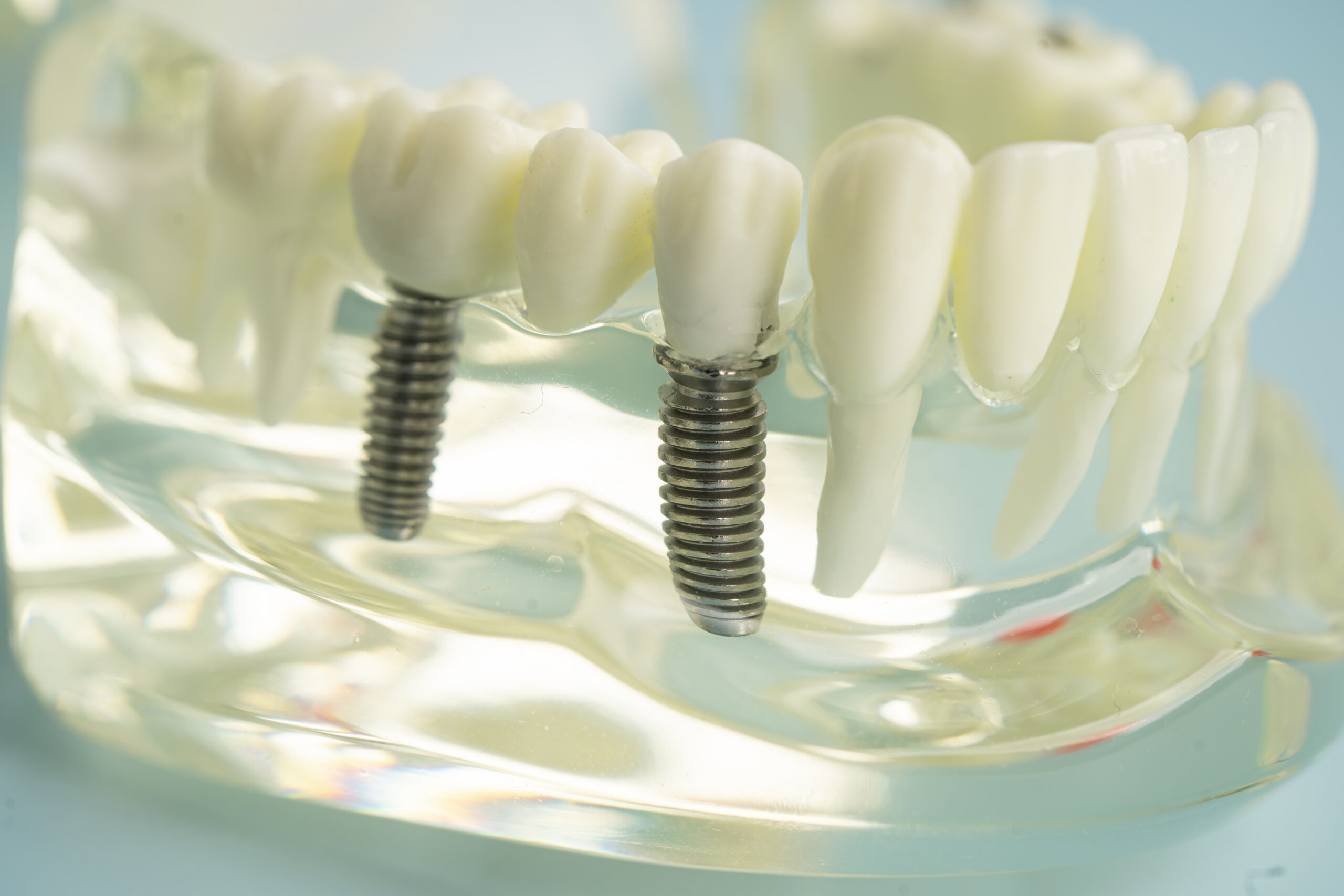 Dental implants tooth replacement